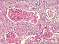 肾盂积水伴肾鳞状细胞癌图13