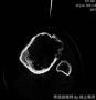 左胫骨近端肿块-上海市骨与关节肿瘤读片2013(2-4)-上海交大附属市六院提供图4