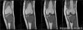 左胫骨近端肿块-上海市骨与关节肿瘤读片2013(2-4)-上海交大附属市六院提供图6