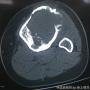 左胫骨近端肿块-上海市骨与关节肿瘤读片2013(2-4)-上海交大附属市六院提供图5