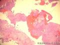 左胫骨近端肿块-上海市骨与关节肿瘤读片2013(2-4)-上海交大附属市六院提供图8