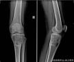 左胫骨近端肿块-上海市骨与关节肿瘤读片2013(2-4)-上海交大附属市六院提供图2