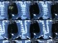 颈4椎体肿瘤图3
