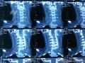颈4椎体肿瘤图2