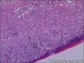子宫粘膜下肌瘤，肌瘤中见内膜腺体，是否报内膜异位症。图3