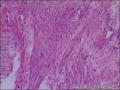 子宫粘膜下肌瘤，肌瘤中见内膜腺体，是否报内膜异位症。图5