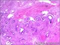 子宫粘膜下肌瘤，肌瘤中见内膜腺体，是否报内膜异位症。图9