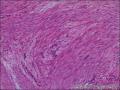 子宫粘膜下肌瘤，肌瘤中见内膜腺体，是否报内膜异位症。图8