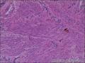 子宫粘膜下肌瘤，肌瘤中见内膜腺体，是否报内膜异位症。图7