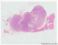 盆腔腹腔占位-上海市骨与软组织肿瘤读片2013(2-6）复旦大学中山医院提供图1