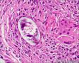 结肠粘膜，M/24，寄生虫？图16