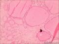 考虑为结节性甲状腺肿伴纤维化钙化囊性变图16