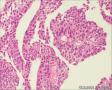 膀胱新生物图13