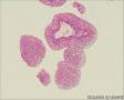 膀胱新生物图8