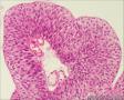 膀胱新生物图11