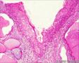 宫颈，湿疣性鳞癌（Warty (Condylomatous) Carcinoma）？图27