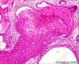 宫颈，湿疣性鳞癌（Warty (Condylomatous) Carcinoma）？图33