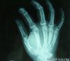 右手肿块-上海市骨与软组织肿瘤读片2013（2-7）复旦大学肿瘤医院提供图2