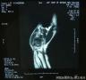 右手肿块-上海市骨与软组织肿瘤读片2013（2-7）复旦大学肿瘤医院提供图3