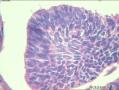 基底细胞乳头状瘤？基底细胞癌？。。。。。。。。。。。。。图20