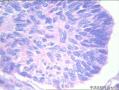 基底细胞乳头状瘤？基底细胞癌？。。。。。。。。。。。。。图21
