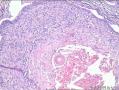 基底细胞乳头状瘤？基底细胞癌？。。。。。。。。。。。。。图17