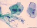 宫颈细胞图20