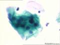 宫颈细胞图15