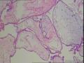 请大家看看这例绒毛是不是部分性水泡状胎块图12