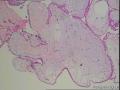 请大家看看这例绒毛是不是部分性水泡状胎块图17
