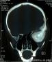 精彩病例-额颞眶肿块-上海市骨与软组织病理读片（3-1）-复旦大学肿瘤医院提供图1