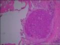 快速报乳腺周围型导管内乳头状瘤，慢的没浸润吧，导管扩张图3