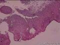 求助宫颈CIN1级伴HPV感染累及腺体图2