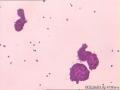 胸水细胞学，是腺癌吗图2