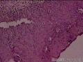 求助宫颈CIN1级伴HPV感染累及腺体图8