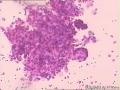 胸水细胞学，是腺癌吗图3