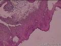 求助宫颈CIN1级伴HPV感染累及腺体图3