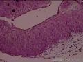 求助宫颈CIN1级伴HPV感染累及腺体图13