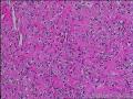 求会诊，隆突还是神经鞘，纤维组织细胞瘤图10
