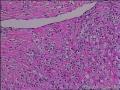 求会诊，隆突还是神经鞘，纤维组织细胞瘤图7