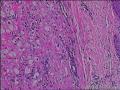 求会诊，隆突还是神经鞘，纤维组织细胞瘤图8