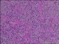 求会诊，隆突还是神经鞘，纤维组织细胞瘤图29