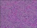 求会诊，隆突还是神经鞘，纤维组织细胞瘤图28