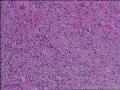 求会诊，隆突还是神经鞘，纤维组织细胞瘤图34