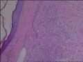 求会诊，隆突还是神经鞘，纤维组织细胞瘤图25