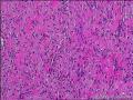 求会诊，隆突还是神经鞘，纤维组织细胞瘤图11