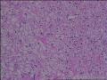 求会诊，隆突还是神经鞘，纤维组织细胞瘤图27