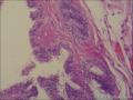 子宫前壁浆膜面结节，我考虑转移癌种植结节！图19
