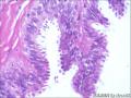 子宫前壁浆膜面结节，我考虑转移癌种植结节！图27
