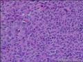 面部肿物，是多形性腺瘤么，有很多血管，请会诊图16